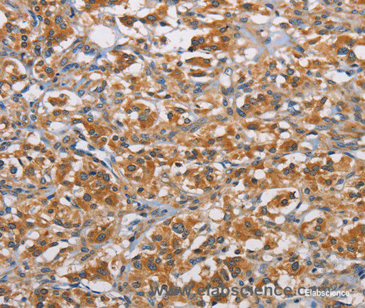 Immunohistochemistry of paraffin-embedded Human thyroid cancer tissue using RICTOR Polyclonal Antibody at dilution 1:40