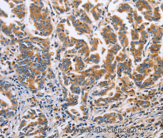 Immunohistochemistry of paraffin-embedded Human gasrtic cancer tissue using DOK4 Polyclonal Antibody at dilution 1:60