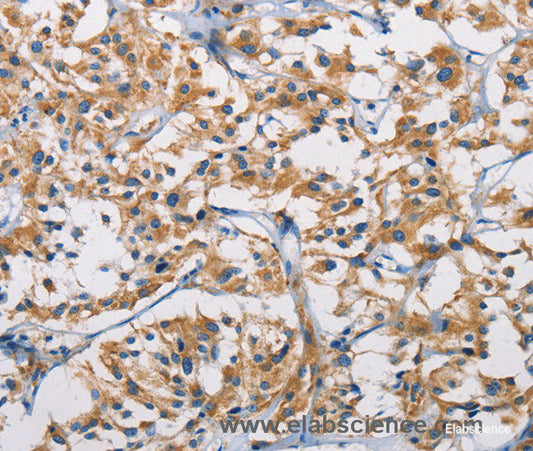 Immunohistochemistry of paraffin-embedded Human thyroid cancer tissue using HK1 Polyclonal Antibody at dilution 1:50