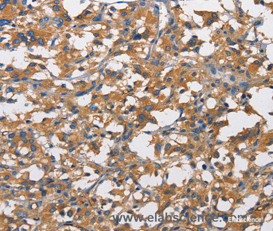 Immunohistochemistry of paraffin-embedded Human thyroid cancer tissue using CD73 Polyclonal Antibody at dilution 1:50