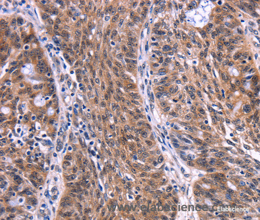 Immunohistochemistry of paraffin-embedded Human ovarian cancer tissue using EIF2AK4 Polyclonal Antibody at dilution 1:50