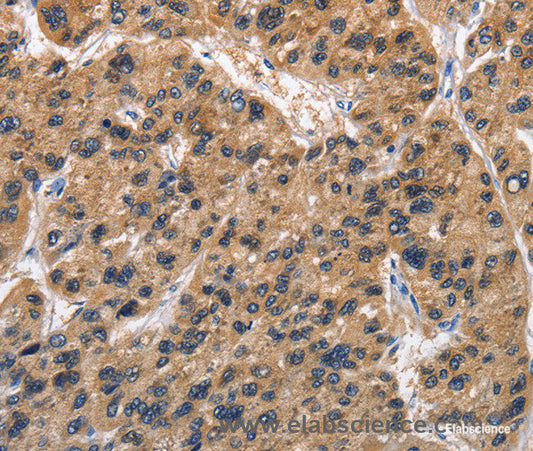 Immunohistochemistry of paraffin-embedded Human liver cancer tissue using ABI3BP Polyclonal Antibody at dilution 1:50