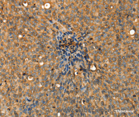 Immunohistochemistry of paraffin-embedded Human cervical cancer tissue using ADCY3 Polyclonal Antibody at dilution 1:30
