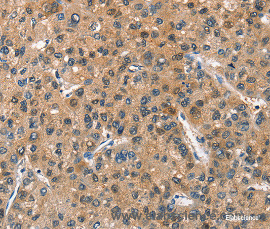 Immunohistochemistry of paraffin-embedded Human liver cancer tissue using ASB2 Polyclonal Antibody at dilution 1:40