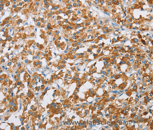 Immunohistochemistry of paraffin-embedded Human thyroid cancer tissue using BDH1 Polyclonal Antibody at dilution 1:60