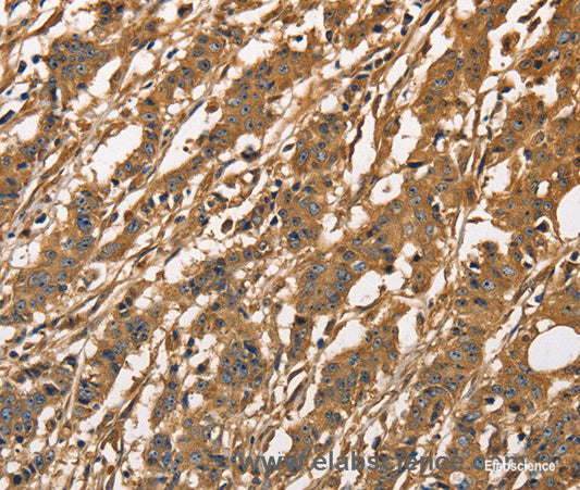 Immunohistochemistry of paraffin-embedded Human gasrtic cancer tissue using CAPZA3 Polyclonal Antibody at dilution 1:40