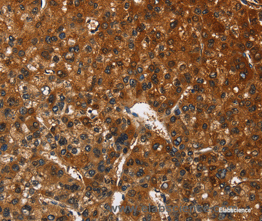 Immunohistochemistry of paraffin-embedded Human liver cancer tissue using CATSPER4 Polyclonal Antibody at dilution 1:50