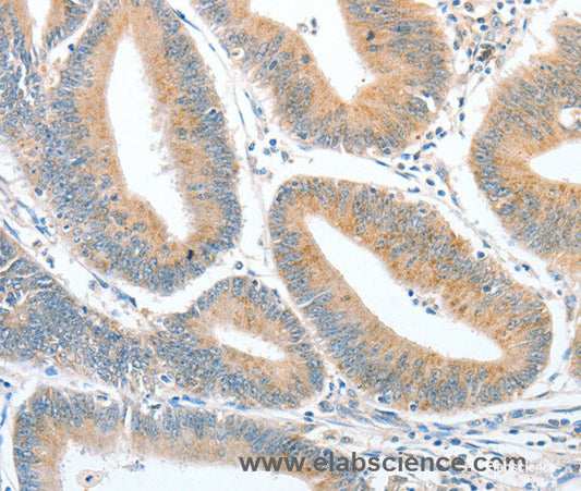 Immunohistochemistry of paraffin-embedded Human colon cancer tissue using CKAP2 Polyclonal Antibody at dilution 1:50