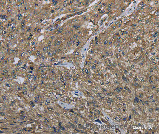 Immunohistochemistry of paraffin-embedded Human esophagus cancer tissue using CLPS Polyclonal Antibody at dilution 1:40
