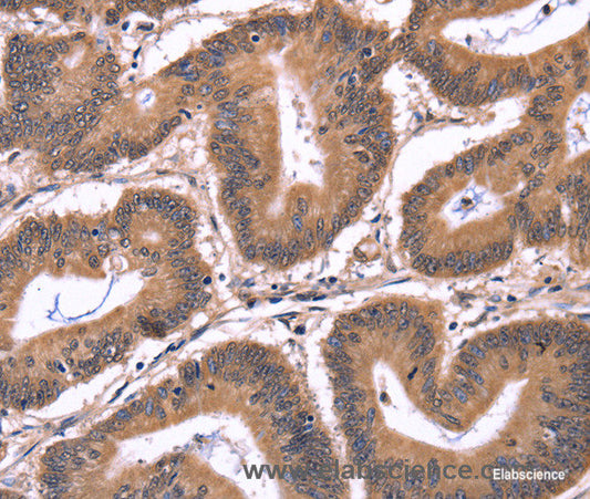Immunohistochemistry of paraffin-embedded Human colon cancer tissue using CRK Polyclonal Antibody at dilution 1:50