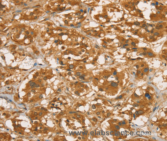 Immunohistochemistry of paraffin-embedded Human thyroid cancer tissue using RBBP8 Polyclonal Antibody at dilution 1:45