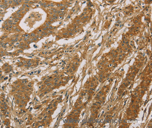 Immunohistochemistry of paraffin-embedded Human gasrtic cancer tissue using CYP39A1 Polyclonal Antibody at dilution 1:50