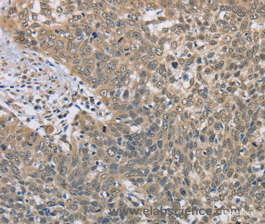 Immunohistochemistry of paraffin-embedded Human cervical cancer tissue using DACH2 Polyclonal Antibody at dilution 1:40
