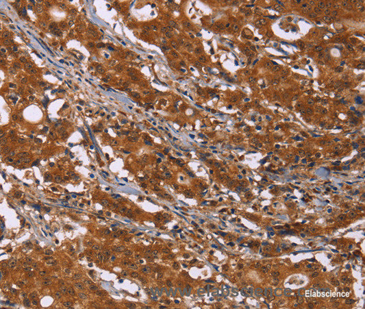 Immunohistochemistry of paraffin-embedded Human gasrtic cancer tissue using DCBLD2 Polyclonal Antibody at dilution 1:50