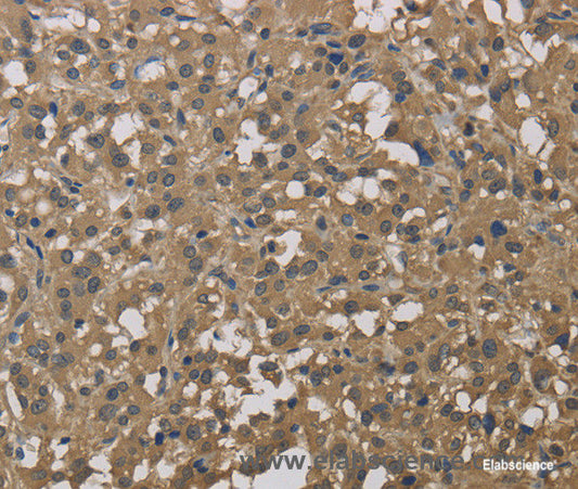 Immunohistochemistry of paraffin-embedded Human thyroid cancer tissue using DCTN3 Polyclonal Antibody at dilution 1:50