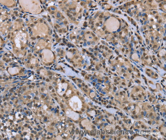Immunohistochemistry of paraffin-embedded Human thyroid cancer tissue using DYNLL1 Polyclonal Antibody at dilution 1:30