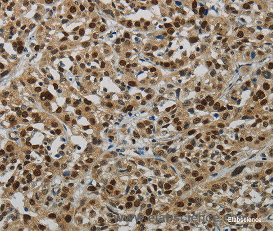 Immunohistochemistry of paraffin-embedded Human esophagus cancer tissue using DNA Ligase1 Polyclonal Antibody at dilution 1:70