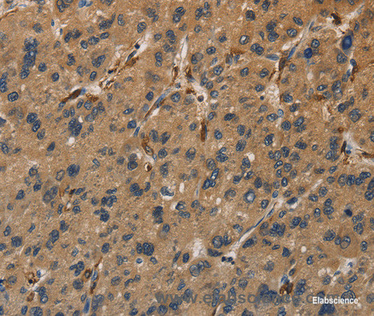 Immunohistochemistry of paraffin-embedded Human liver cancer tissue using UBE2S Polyclonal Antibody at dilution 1:40