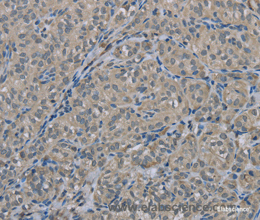 Immunohistochemistry of paraffin-embedded Human thyroid cancer tissue using EDN1 Polyclonal Antibody at dilution 1:30