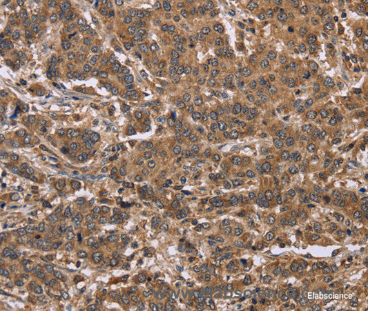 Immunohistochemistry of paraffin-embedded Human liver cancer tissue using FABP6 Polyclonal Antibody at dilution 1:30