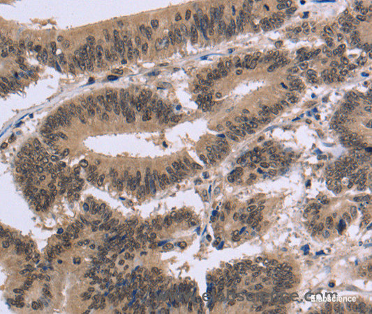 Immunohistochemistry of paraffin-embedded Human colon cancer tissue using FAM107A Polyclonal Antibody at dilution 1:30