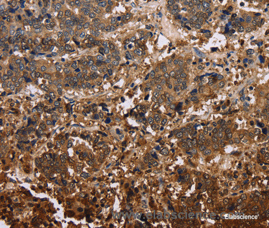 Immunohistochemistry of paraffin-embedded Human liver cancer tissue using FBP2 Polyclonal Antibody at dilution 1:40