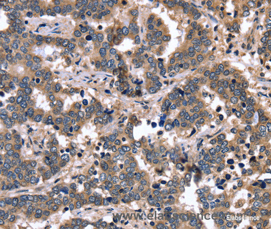 Immunohistochemistry of paraffin-embedded Human liver cancer tissue using FGFR1OP2 Polyclonal Antibody at dilution 1:40