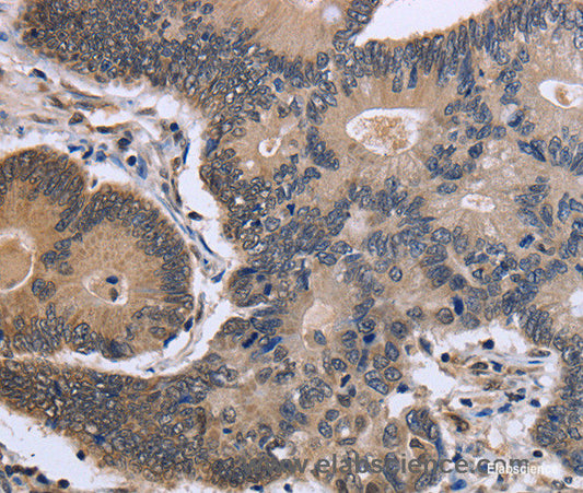 Immunohistochemistry of paraffin-embedded Human colon cancer tissue using FSTL1 Polyclonal Antibody at dilution 1:40
