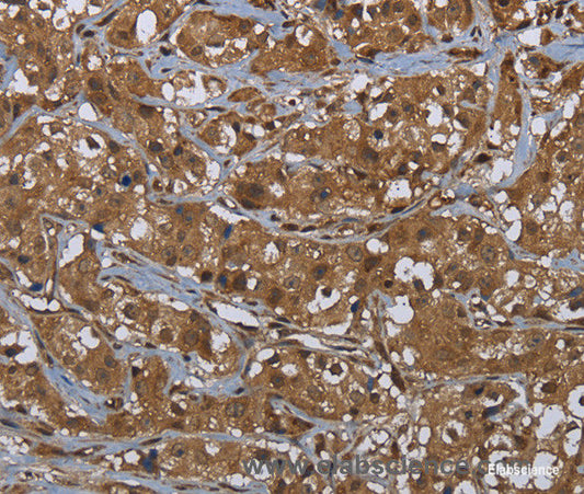 Immunohistochemistry of paraffin-embedded Human breast cancer tissue using GCK Polyclonal Antibody at dilution 1:60