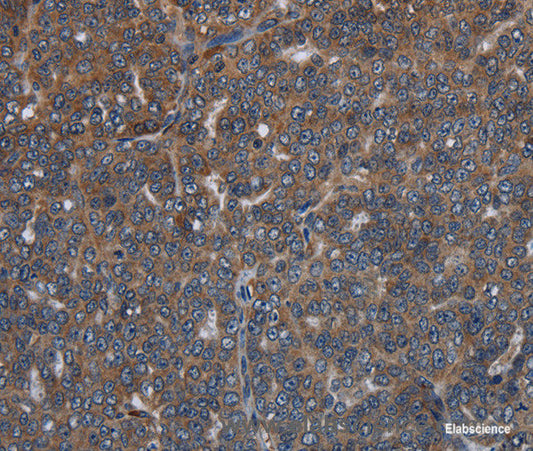 Immunohistochemistry of paraffin-embedded Human ovarian cancer tissue using LETMD1 Polyclonal Antibody at dilution 1:30