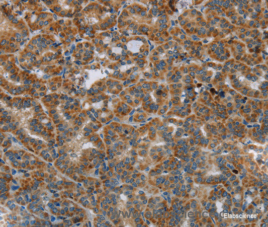 Immunohistochemistry of paraffin-embedded Human thyroid cancer tissue using HSD17B14 Polyclonal Antibody at dilution 1:40