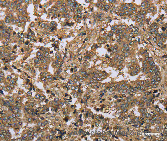 Immunohistochemistry of paraffin-embedded Human liver cancer tissue using IKBIP Polyclonal Antibody at dilution 1:30