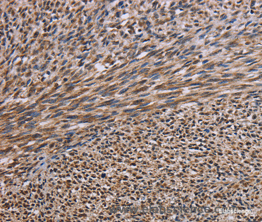 Immunohistochemistry of paraffin-embedded Human sarcoma tissue using KIF2A Polyclonal Antibody at dilution 1:30
