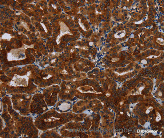 Immunohistochemistry of paraffin-embedded Human thyroid cancer tissue using KLHL1 Polyclonal Antibody at dilution 1:30