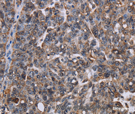 Immunohistochemistry of paraffin-embedded Human ovarian cancer tissue using LDOC1 Polyclonal Antibody at dilution 1:50