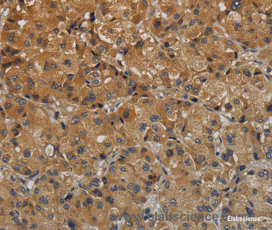 Immunohistochemistry of paraffin-embedded Human liver cancer tissue using TAB1 Polyclonal Antibody at dilution 1:40