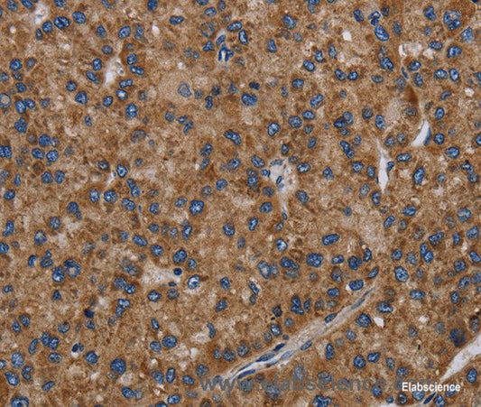 Immunohistochemistry of paraffin-embedded Human liver cancer tissue using NECTIN2 Polyclonal Antibody at dilution 1:40