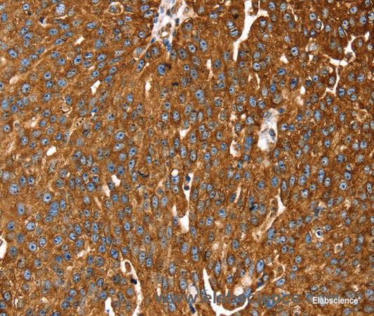 Immunohistochemistry of paraffin-embedded Human breast cancer tissue using RASSF3 Polyclonal Antibody at dilution 1:35