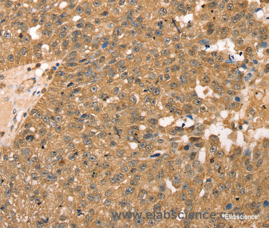 Immunohistochemistry of paraffin-embedded Human breast cancer tissue using RPLP2 Polyclonal Antibody at dilution 1:40