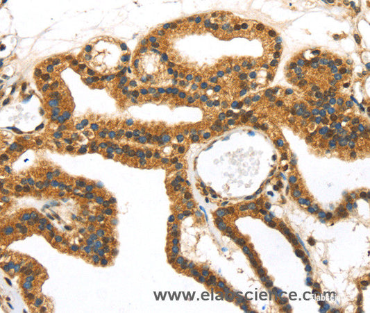 Immunohistochemistry of paraffin-embedded Human thyroid cancer tissue using SERPINB8 Polyclonal Antibody at dilution 1:40