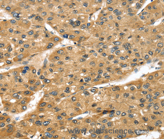 Immunohistochemistry of paraffin-embedded Human liver cancer tissue using STX8 Polyclonal Antibody at dilution 1:45