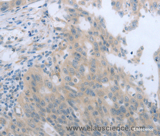 Immunohistochemistry of paraffin-embedded Human breast cancer tissue using TNK2 Polyclonal Antibody at dilution 1:70