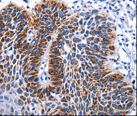Immunohistochemistry of paraffin-embedded Human liver cancer tissue using RAB25 Polyclonal Antibody at dilution 1:50