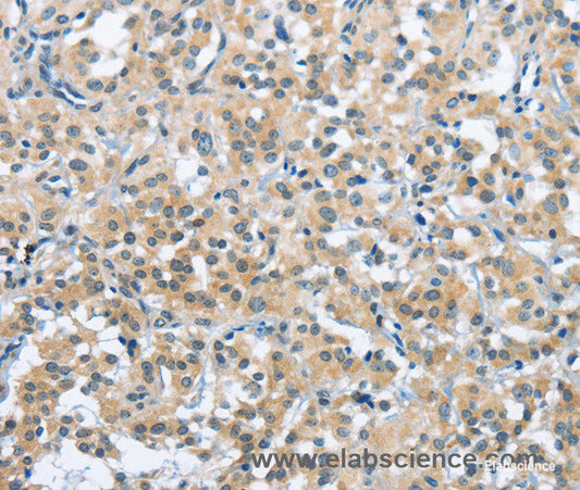 Immunohistochemistry of paraffin-embedded Human thyroid cancer tissue using TRDMT1 Polyclonal Antibody at dilution 1:40