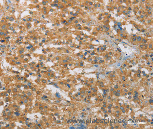 Immunohistochemistry of paraffin-embedded Human thyroid cancer tissue using FASLG Polyclonal Antibody at dilution 1:30