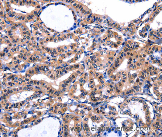 Immunohistochemistry of paraffin-embedded Human thyroid cancer tissue using FBN1 Polyclonal Antibody at dilution 1:47