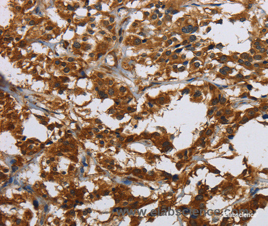 Immunohistochemistry of paraffin-embedded Human thyroid cancer tissue using Claudin 2 Polyclonal Antibody at dilution 1:30