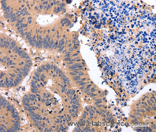 Immunohistochemistry of paraffin-embedded Human colon cancer tissue using Glucocorticoid Receptor Polyclonal Antibody at dilution 1:50