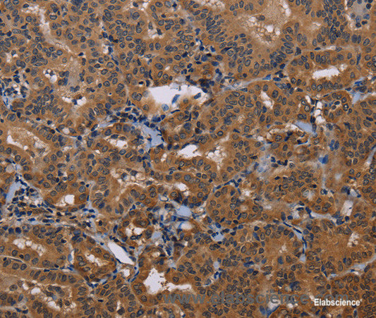 Immunohistochemistry of paraffin-embedded Human thyroid cancer tissue using GRK1 Polyclonal Antibody at dilution 1:30