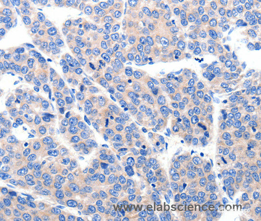 Immunohistochemistry of paraffin-embedded Human ovarian cancer tissue using KCNH8 Polyclonal Antibody at dilution 1:50